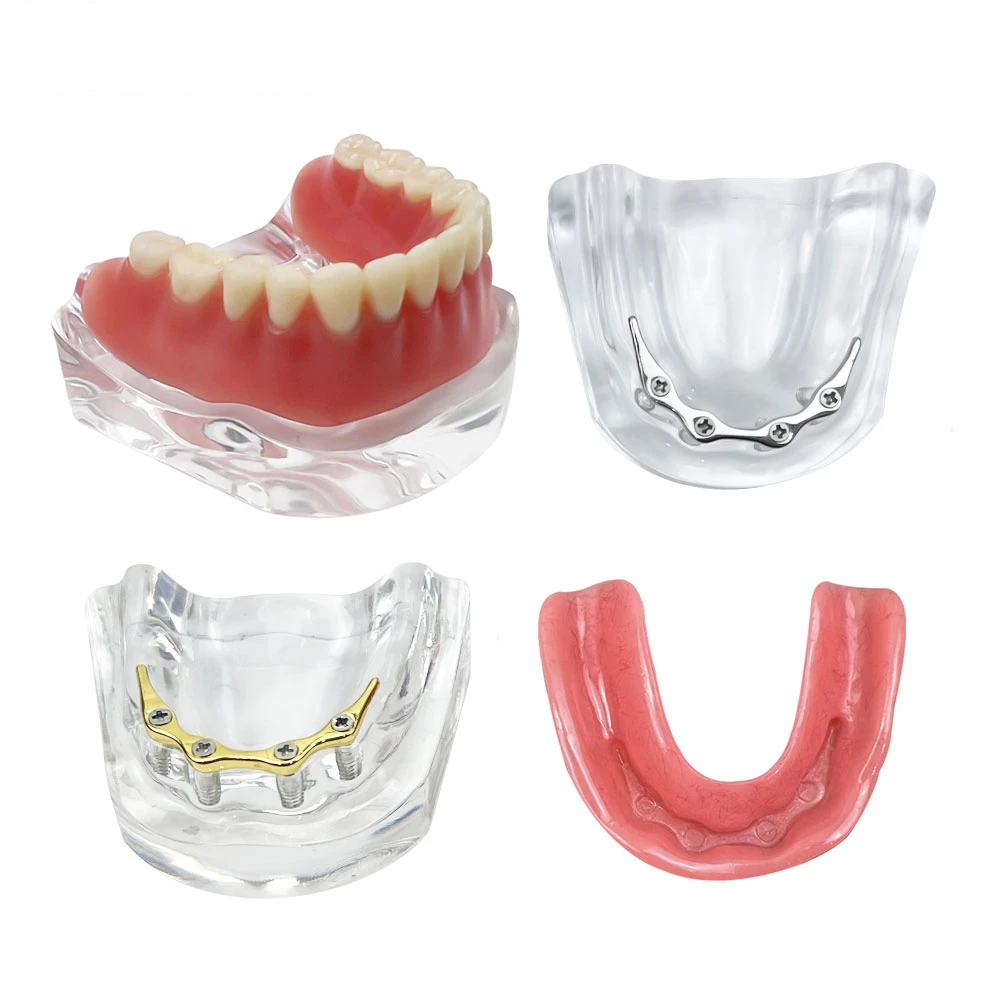 Removable Overdenture Teeth Model With 4 Implants Lower Jaw Bridge Teaching Demo for Dentist Patient Golden/Silver Bar Model