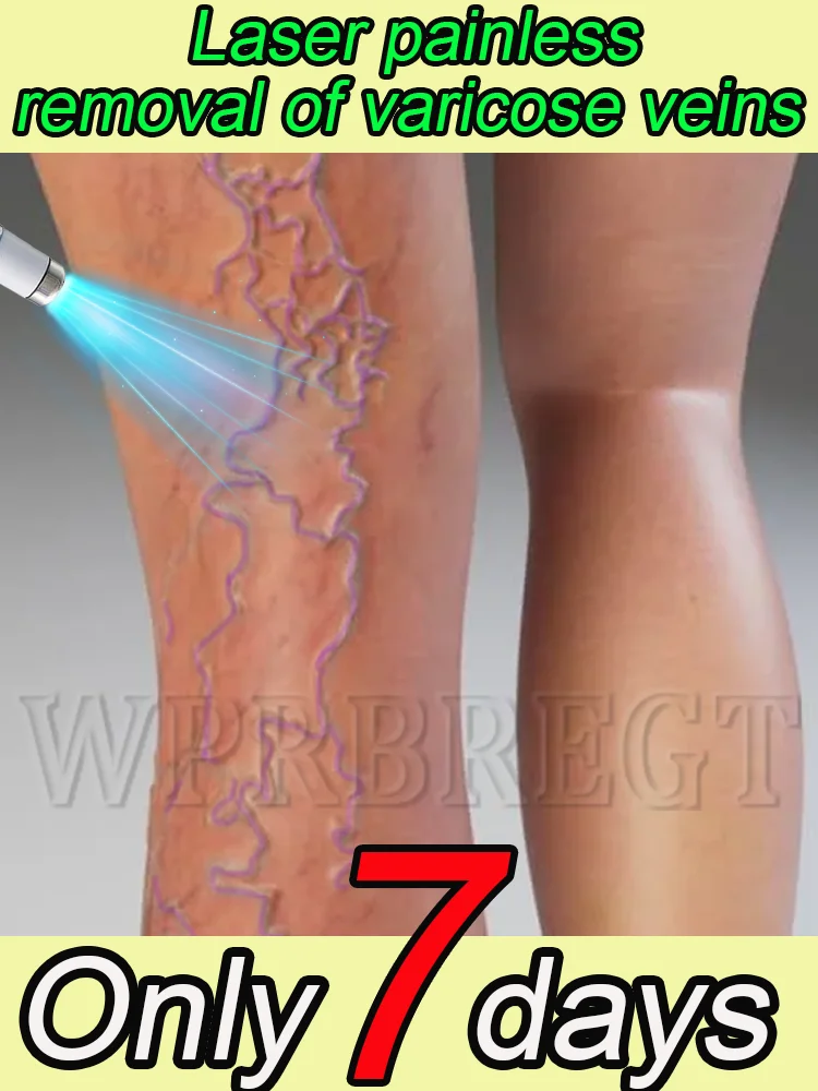 

Quickly remove varicose veins and solve vascular problems of veins