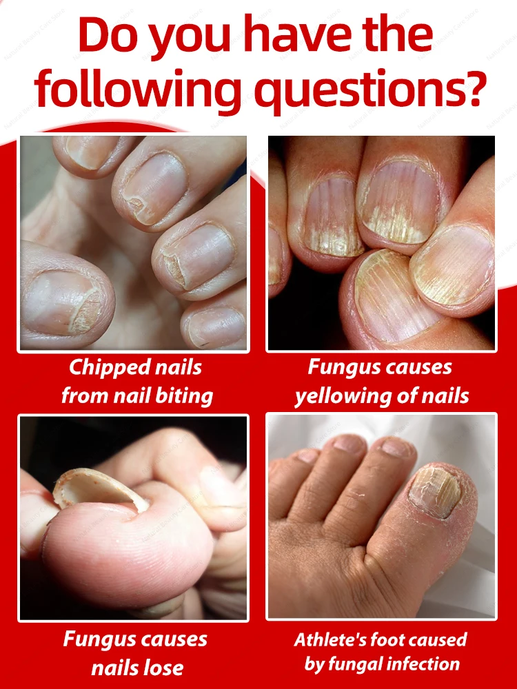 Fungal Nail Repair Fast Onychomycosis Fungus Nails