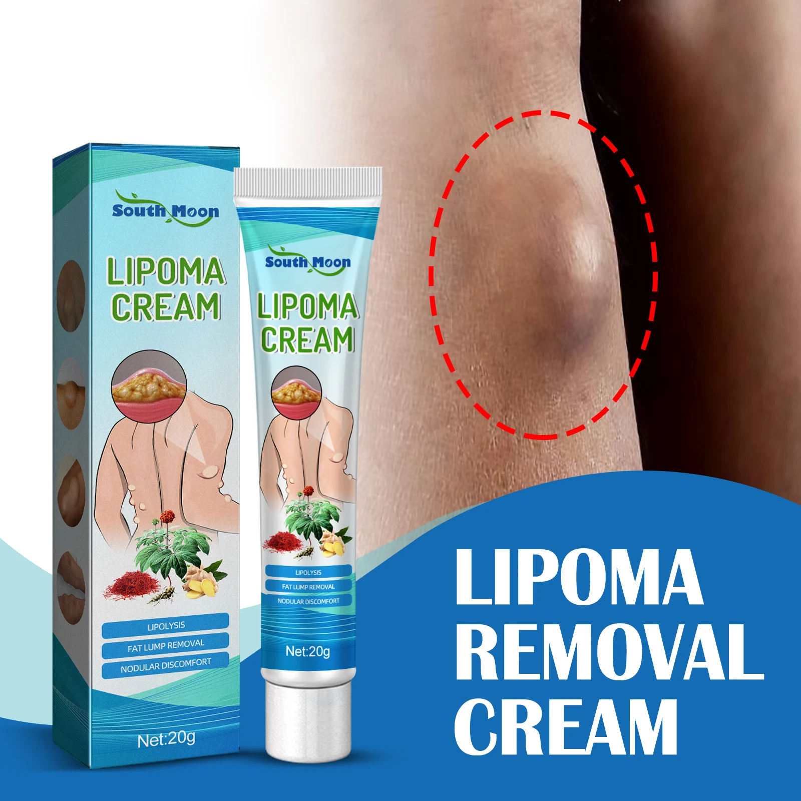 Lipoma Removal Cream Effectively Reduce Inflammation Treat Subcutaneous Lumps Fat Pack Shoulder Remove 20g