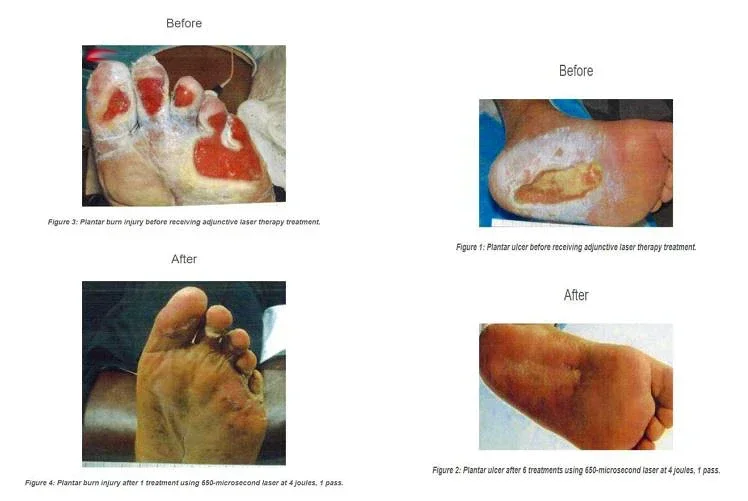 Lasers à froid pour usage domestique, dispositif de thérapie arthritique pour les instituts oto, genou, 8W, 650nm, 808nm, déterminer avec une protection, interdite