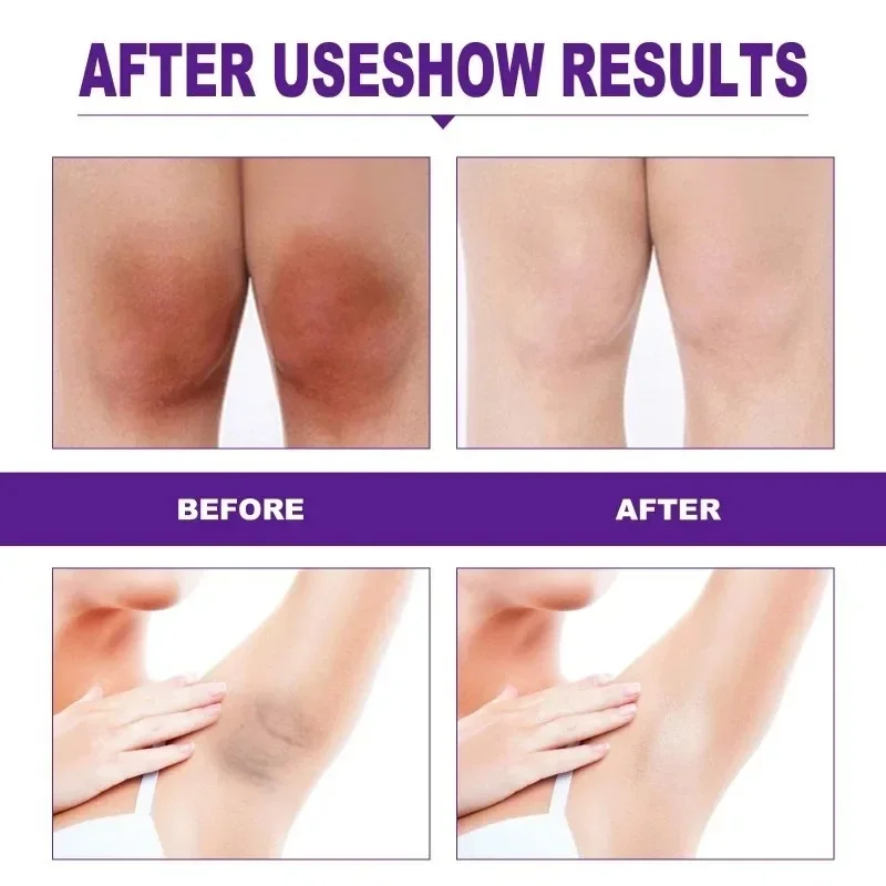 Women Skin Whitening Cream Remove Melanin Emulsion Brighten Private Parts Whiten Cream Inner Thigh Butt Underarm Bleaching Serum