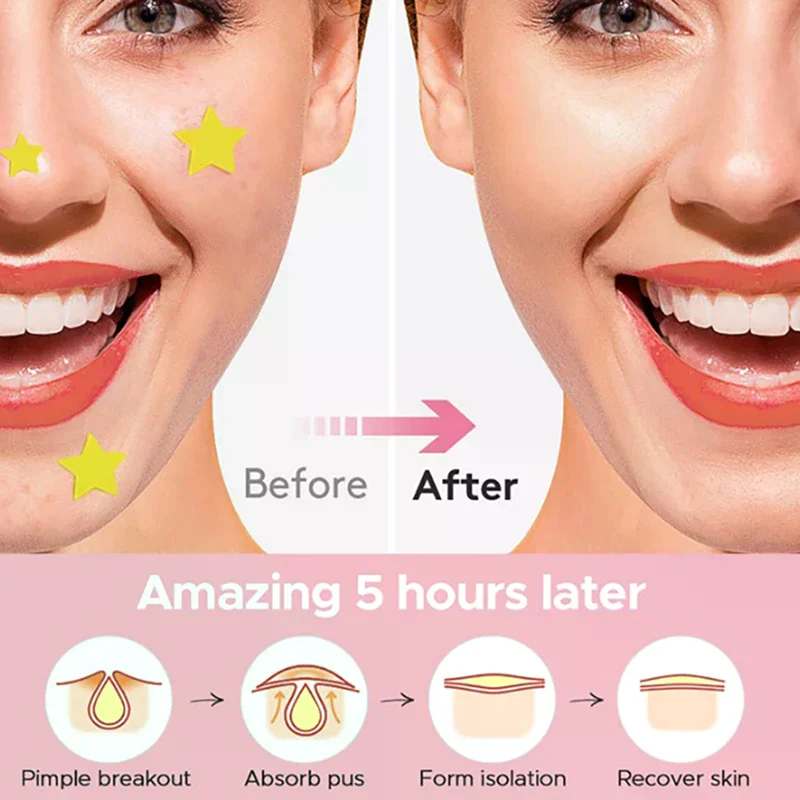 360 قطعة غير مرئية على شكل قلب ونجمة الوجه للعناية بالبشرة حب الشباب بثرة التصحيح شفاء المهنية