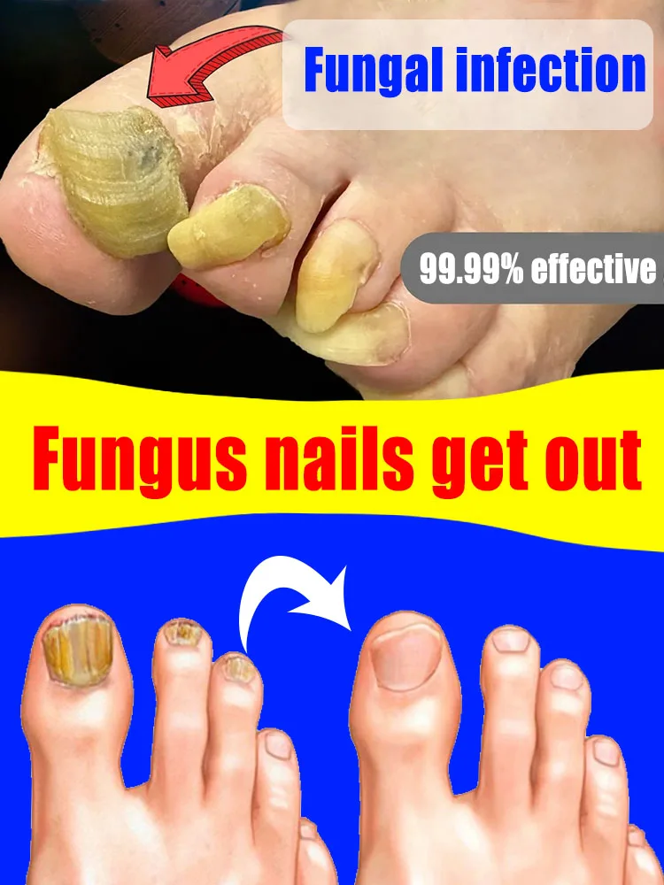 

Eliminate Fungal Nails Permanently