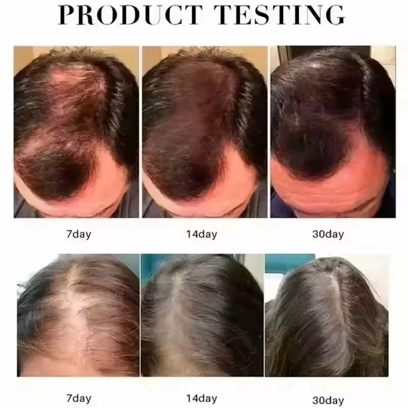 Fast Ginger Hair Growth Spray Roots Grow Anti Hair Loss Hair Regrowth Serum Scalp Damaged Repair Nourish Care Products Women Men
