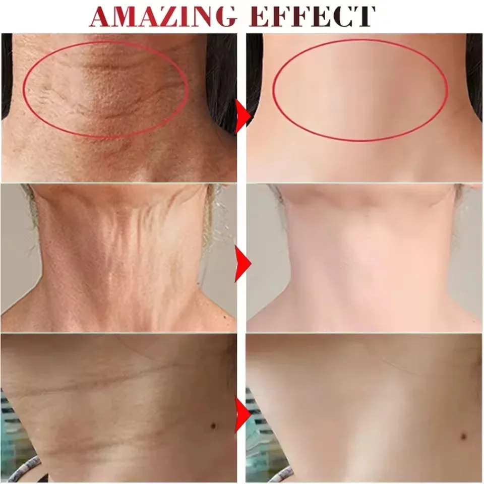 Neck Lines Protein Mask Collagen Eliminate Neck Fine Lines Anti-ageing Lift Rejuvenation Nourish Eliminate Double Chin Skin Care