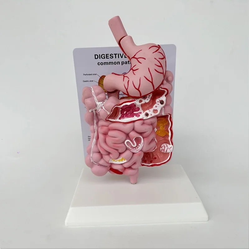 Adult Large Intestinal Pathology Model Human Digestive System Gastrointestinal Anatomy Model Medical Teaching Tools