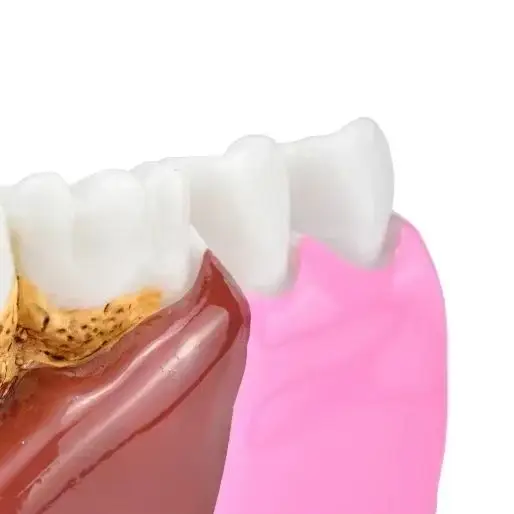 

Зубные кариесы, анатомия, комплексная патология, нерв для устного обучения, модель зубов