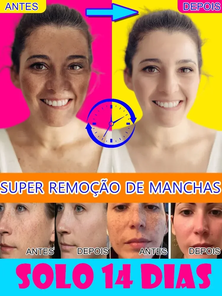 Crema para eliminar pecas, crema para eliminar manchas oscuras de la piel, manchas de la edad, manchas solares, blanqueamiento y pecas