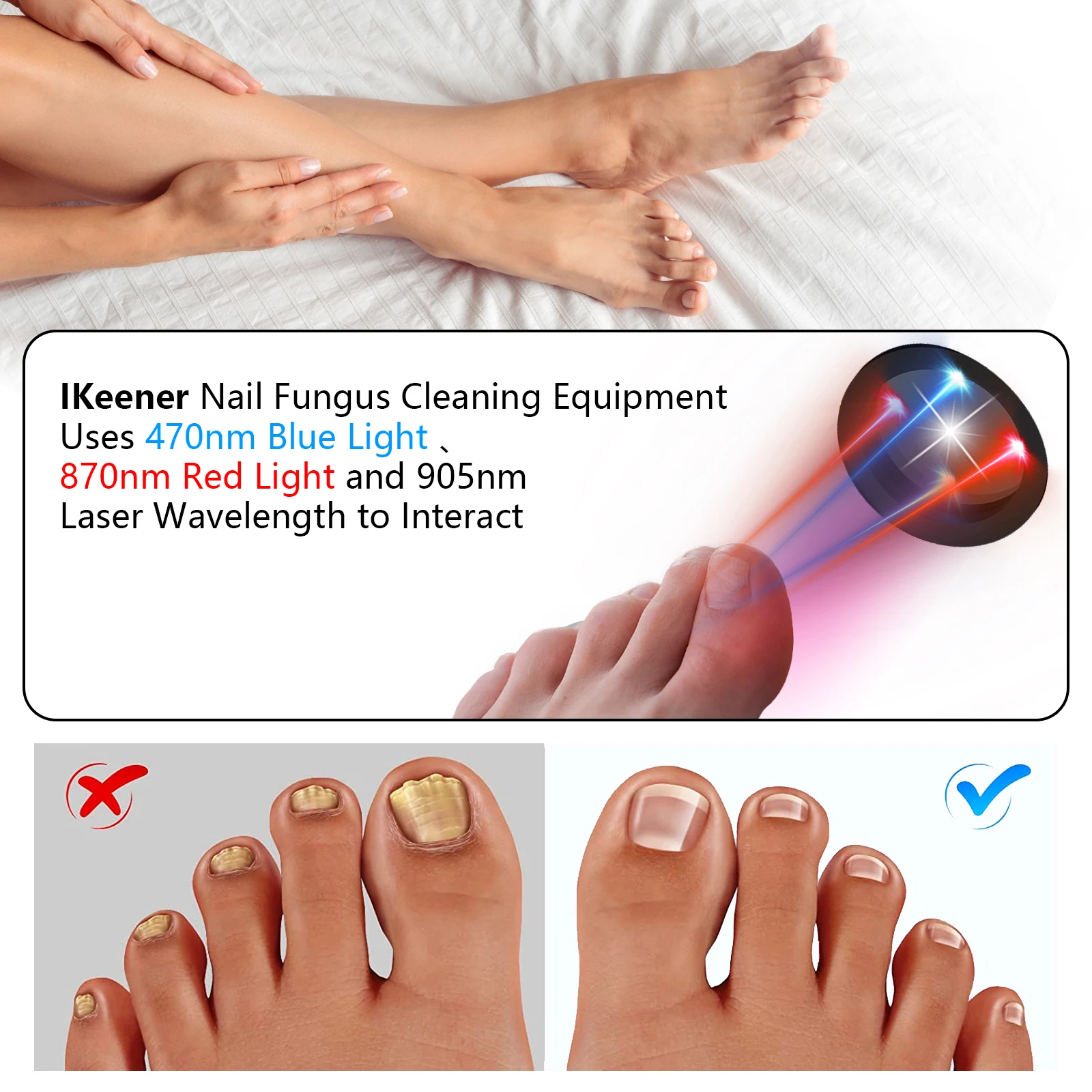 Kts Nagel pilz Laser gerät Zehen nagel Laser therapie gerät Anti-Pilz-Laser gerät für Onycho mykose 910nm 407nm USB-Ladung