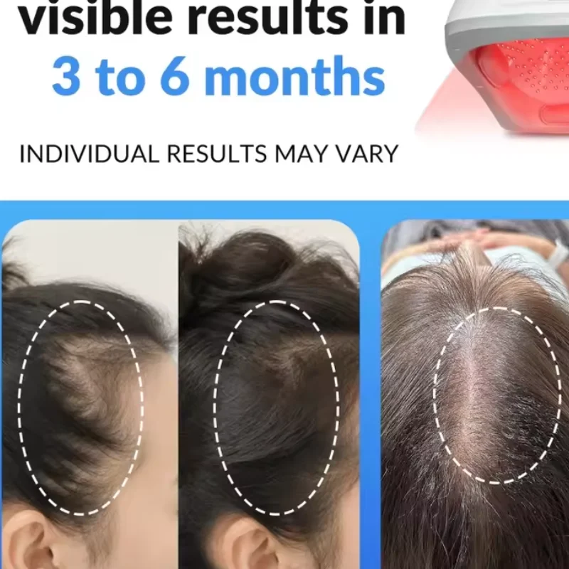 Medical Grade 300 Diodes 650nm 660nm LLLT Laser Cap Helmet for Hair Line Recession Hair Growth Treatment Home