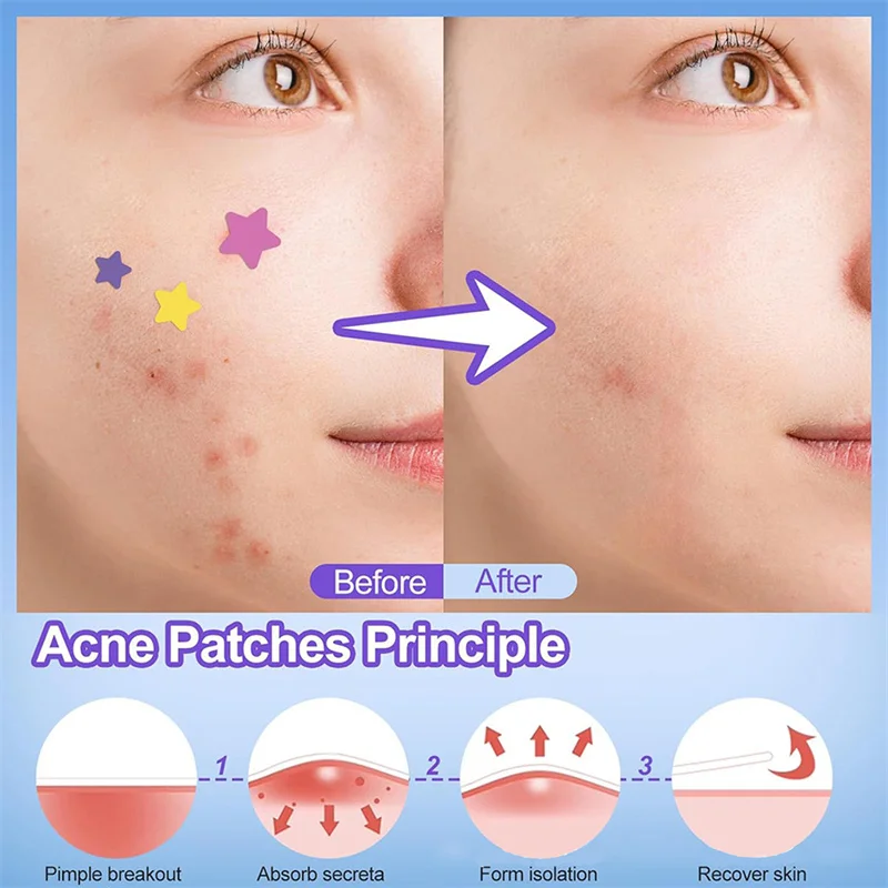 10Pcs Invisible Acne Removal Skin Care Stickers Pentagram Colored Acne Patch Pimple Patch Face Spot Beauty Makeup Tool