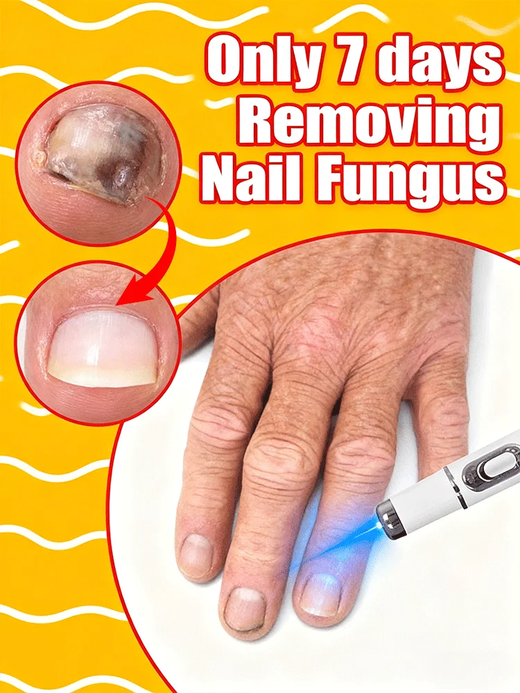 

2025 New Blue Laser care Nail Fungi