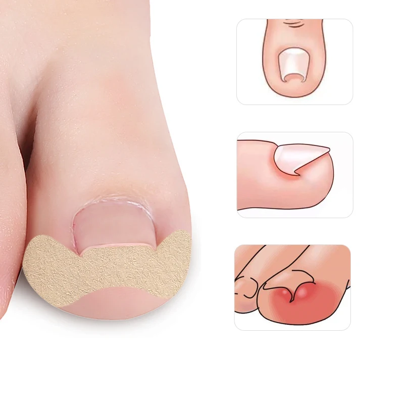 Pexmen 6/12/30Pcs Ingrown Toenail Correction Sticker Adhesive Toenail Patch Toe Nail Treatment Corrector Foot Care Tool