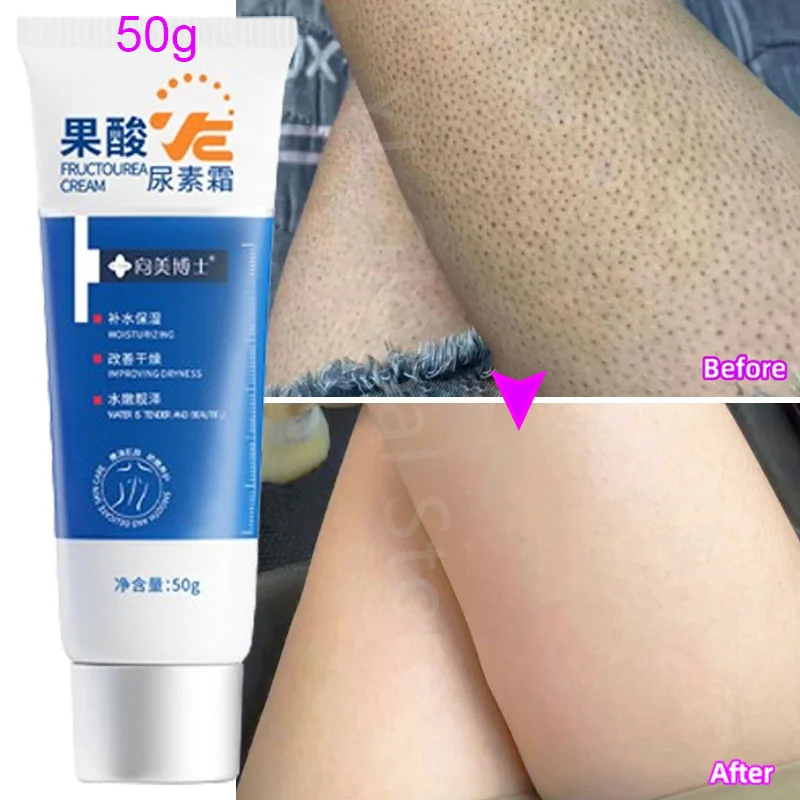 Fruit Acid VE Urea Cream Improve Chicken Skin Keratosis Pilaris Hydrating Moisturizing Rejuvenating Body Lotion Leg Arm Dry Skin