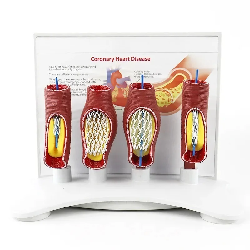 Human Vascular Stent Model Medical Teaching Pathological Anatomy Demonstration