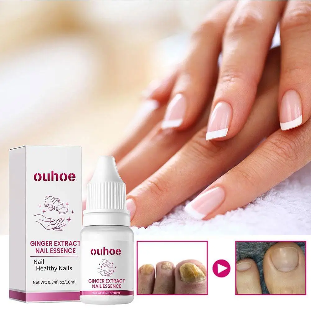 OUHOE 10ml Ginger Nail Essence Nourishing Rough Nails Anti Paronychia Nail Fungal Nail Treatment Essence Hand Foot Care