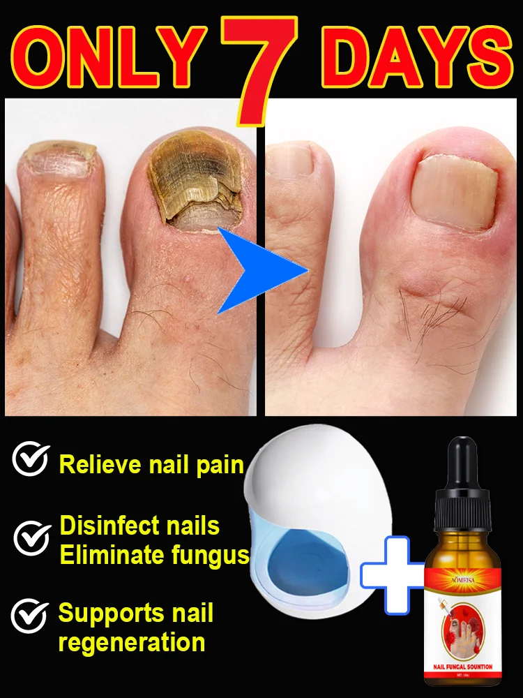 

Onychomycosis ointment + laser treatment device for complete treatment, rapid treatment of onychomycosis and care of foot health