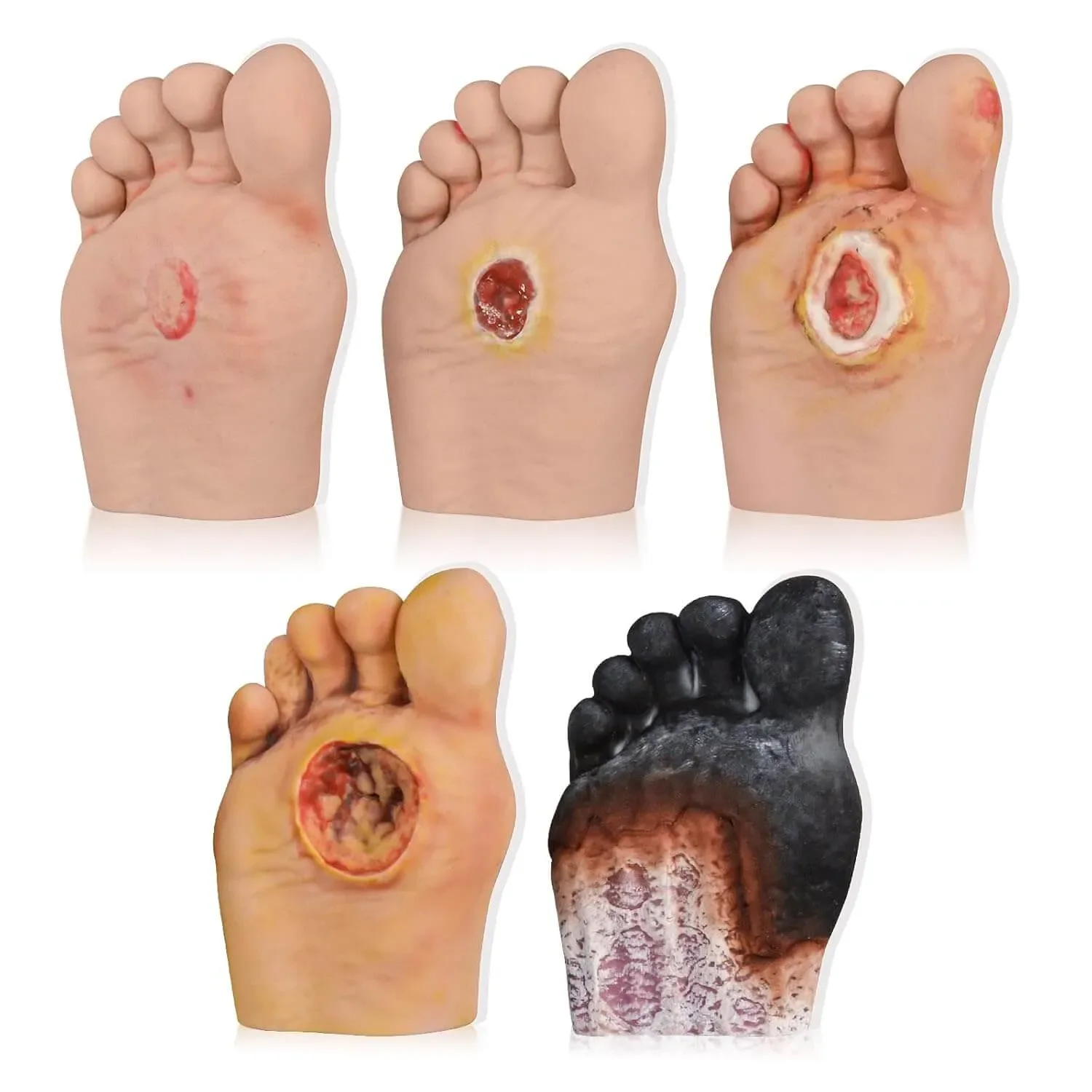 

Ultrassist Diabetic Foot Ulcer Grading Model 5 Stages Human Foot Diabetes Complication Simulator for Anatomy Physiology Educate