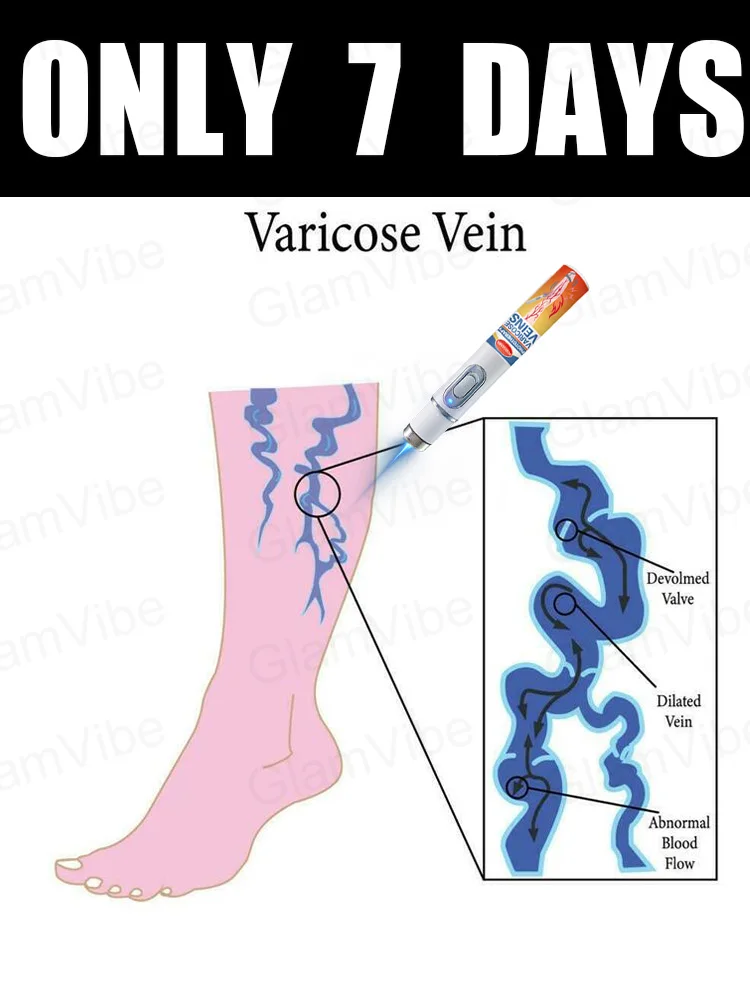 

Leg care tools, blue light pen, varicose veins, 2025 hot sale