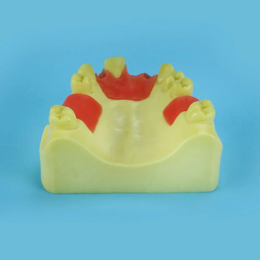 Oral model, maxillary anterior missing implant practice model, dental implant model