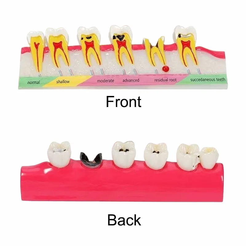 

1Pc Dental Model Dentist Teaching Training Doctor-patient Communication Demo Caries Model Dental Teaching Model Teeth