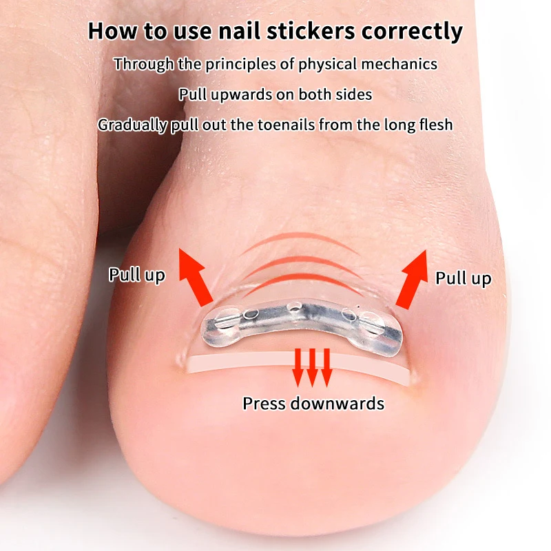 2 pçs adesivos de correção de unhas elástico encravado corretor de unhas remendos adesivo auxiliar invisível tratamento paroníquia recuperar