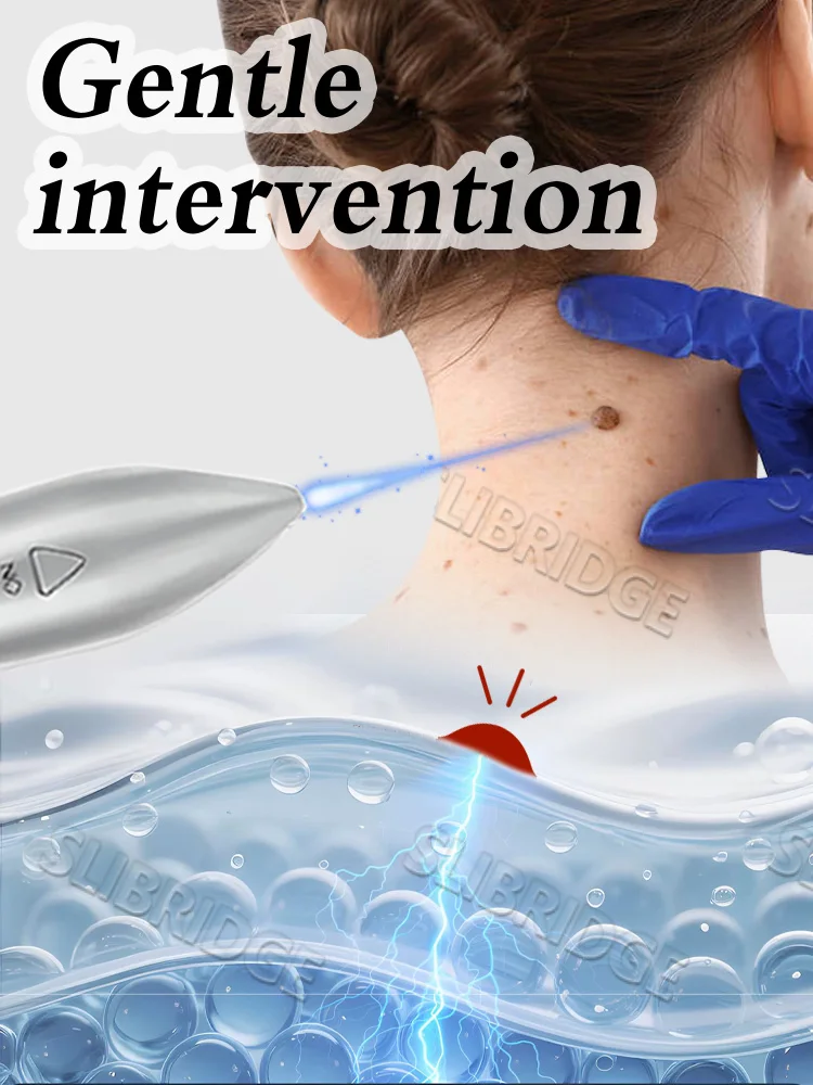 2025 أدوات الليزر المشتركة الجديدة للثآليل الأخمصية. #3