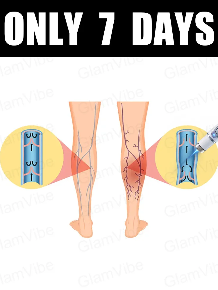 

Leg care tools, blue light pen, varicose veins, 2025 hot sale