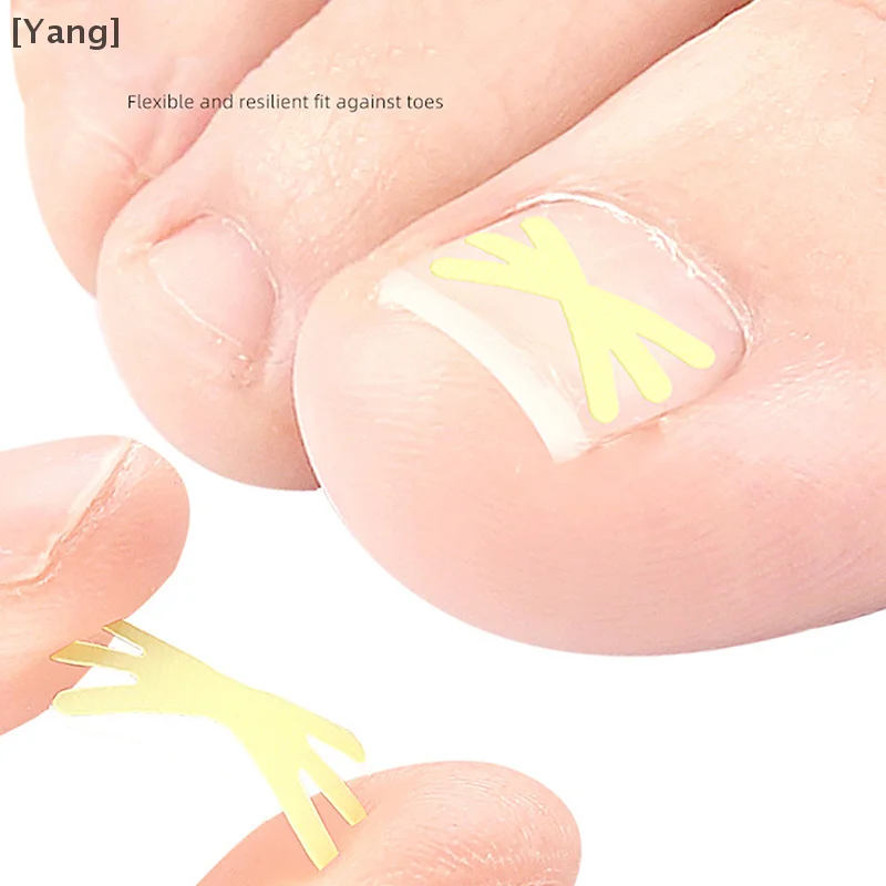 10Pcs Mi Shaped Ingrown Toenail Correction Clip Sticker Pedicure Toe Tools Nail Treatment Elastic Straightening Clip Brace