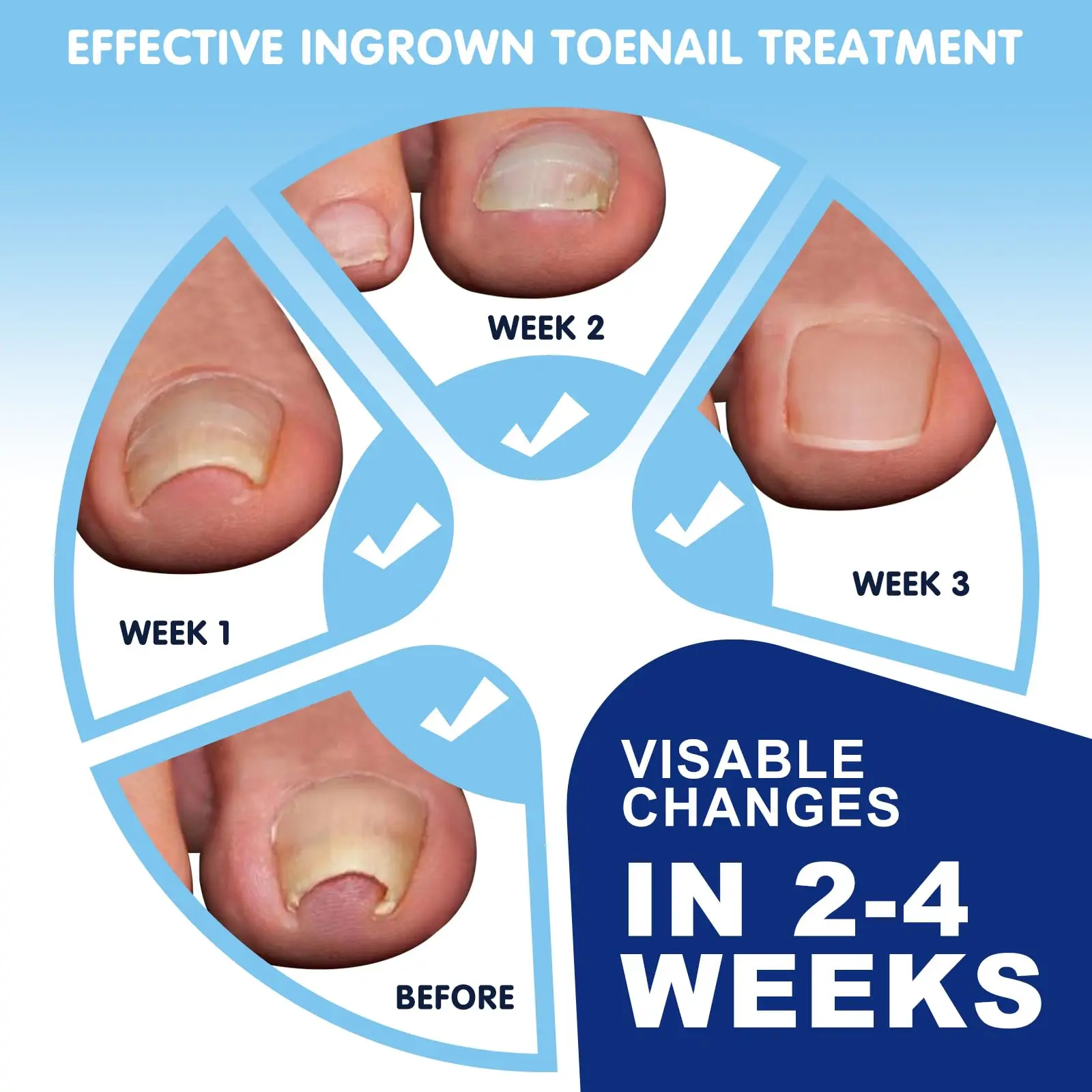 Zestaw do korekcji wrastających paznokci Bezbolesne paski prostujące paznokcie Lifter do paznokci i małe nożyczki Narzędzie do wrastających paznokci