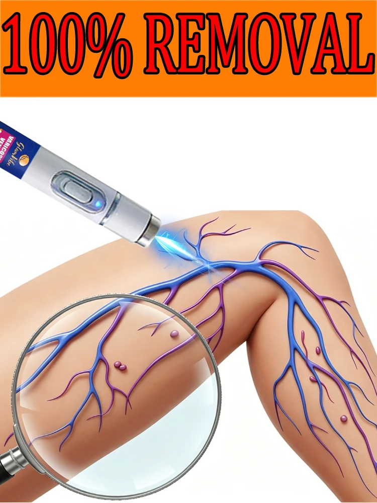 

No need to worry about varicose veins recurring.