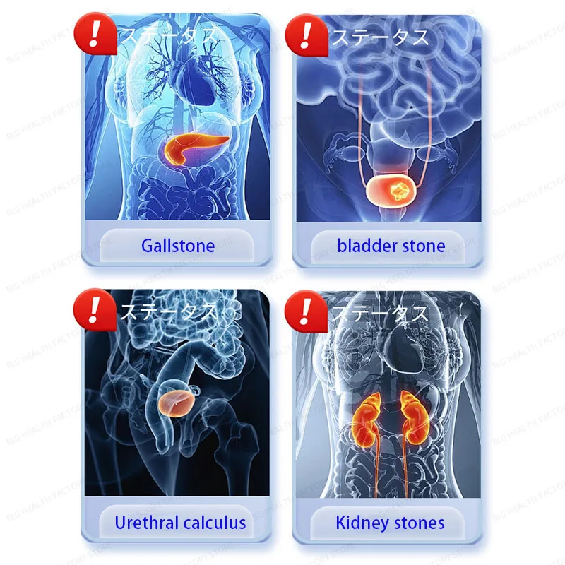 رقعة الأحجار للألم والفائدة والمرارة والأحجار والبطن والغثيان والقلق والقلق والأحجار رقعة الرعاية الصحية #3