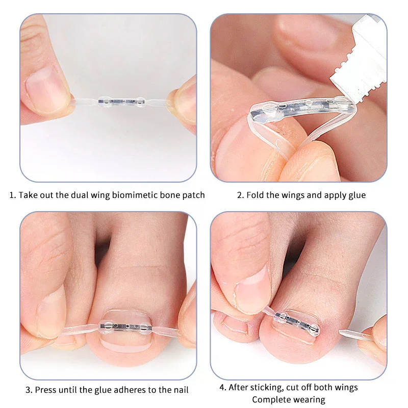 Autocollants de Correction des ongles incarnés élastiques, 2 pièces, patchs auxiliaires invisibles, traitement Paronychia, récupération