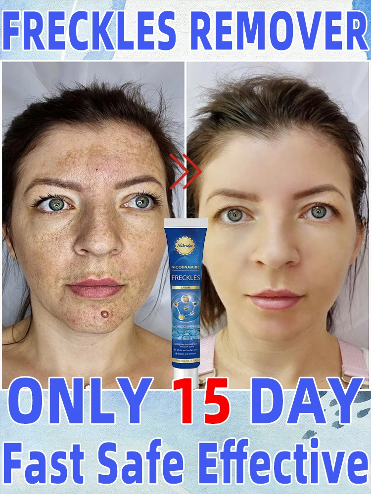 Age Sun Dark Spot Freckles Clear