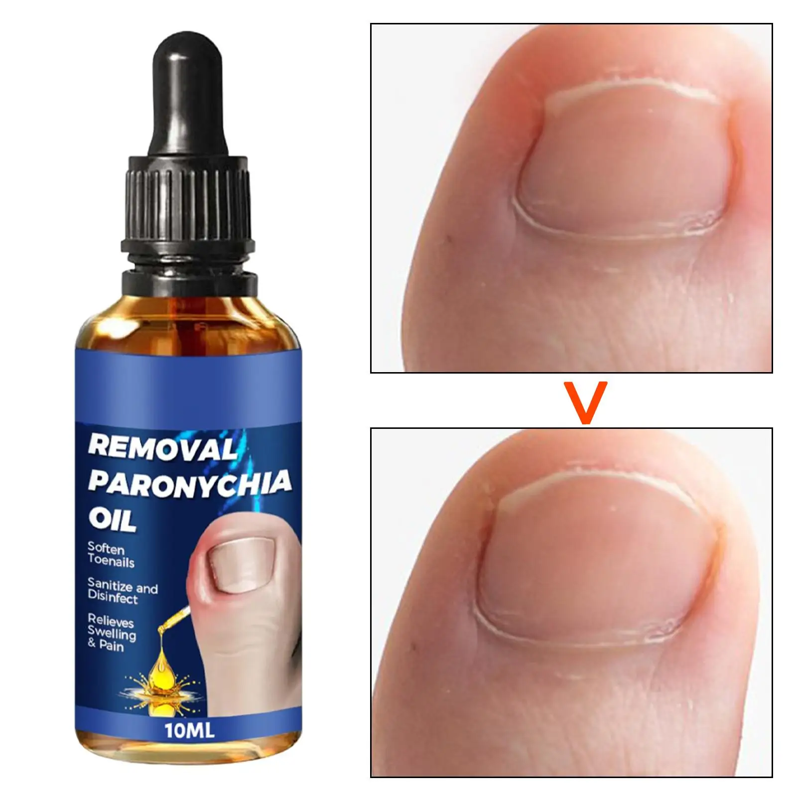 Solução De Tratamento De Pé Unha, reparo Profissional De Unhas De Toe, solução De Cuidados Com As Unhas