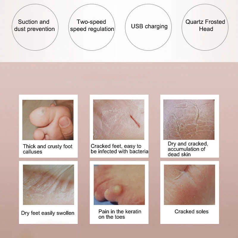 건조하고 완고한 피부 제거를 위한 업그레이드 된 전동 풋 캘러스 리무버 전문 스크러버.