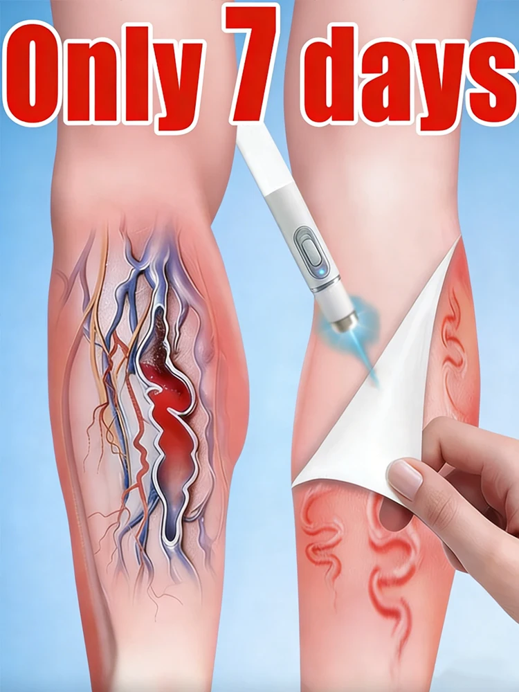 

Синий световой карандаш для лечения вен на обеих ногах, инструмент для ухода за венами