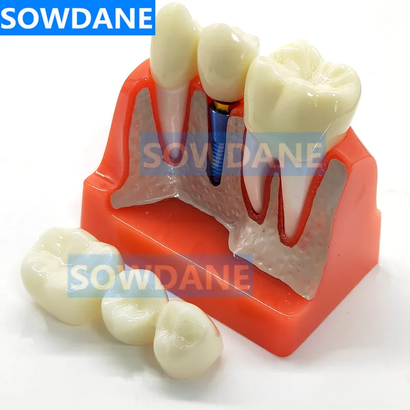 Dental Study Teaching Model Dental Impant Standard Model Removable Teeth ADULT Child TYPODONT Model  Dentist Communication Model