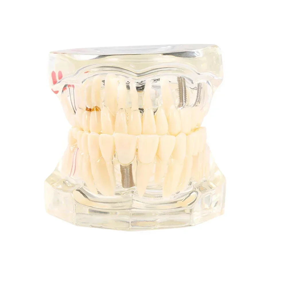 

Dental Models Removable And Restorable Models Of Diseased Teeth For Teaching And Researching Medical And Dental Diseases