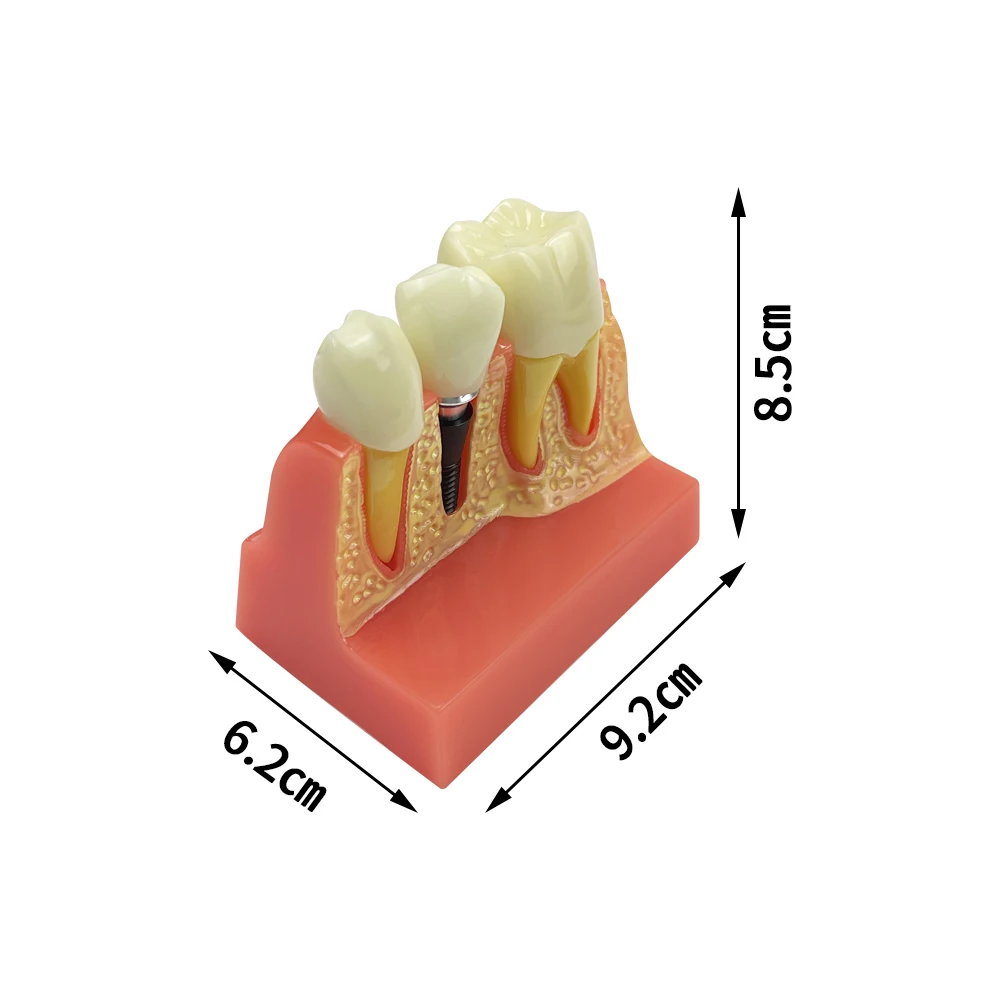 Dental Model 4 Times Dental Implant Analysis Crown Bridge Demonstration Dental Teeth Model Dentistry Demonstration Teeth  Model