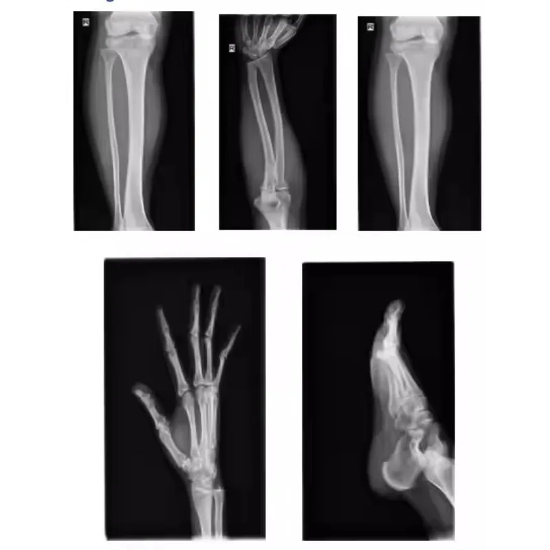 High-quality portable camera-mounted handheld DR X-ray mobile for accurate hospital radiology diagnostics
