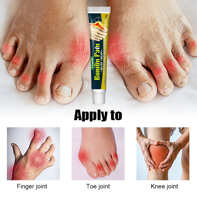 1Pcs Foot Gout Cream Arthritis Bone Thumb Corrector Finger Hallux Toe Bunion Joint Pain Relief Herbal Medical Care Ointment G049