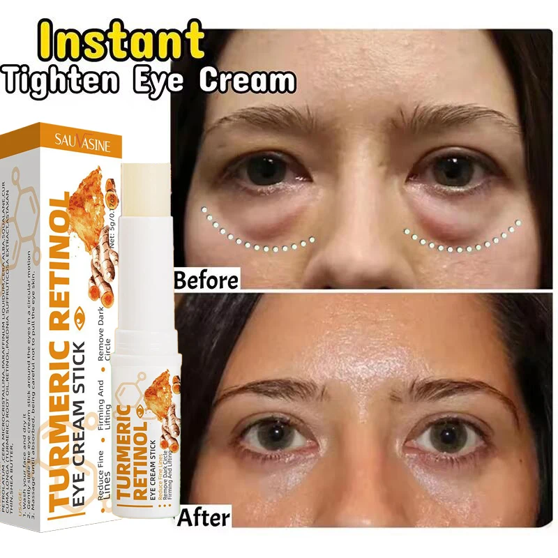 Freckle Whitening Cream Black Dots Melasma Remover Anti Brown Stain Lighten Pigmentation Moisturizing Skin Care Korean Products