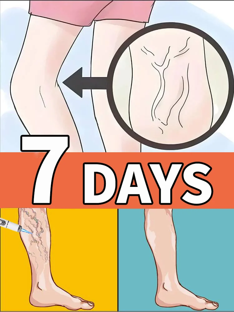 

Keep your legs without varicose veins