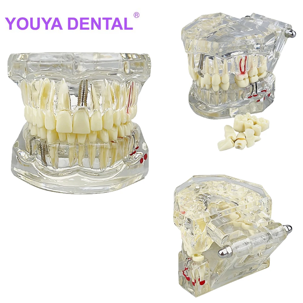 Transparent Dental Model Implant Restoration Bridge Tooth Disease Teaching Analysis Removable Teeth Demonstration Model