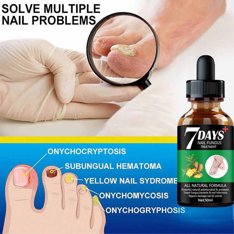 7 Dagen Reparatie Nagel Schimmel Behandelingen Essence Voetverzorging Serum Teen Nagels Schimmelverwijdering Gel Anti-Infectie Onychomycosis(50Ml)