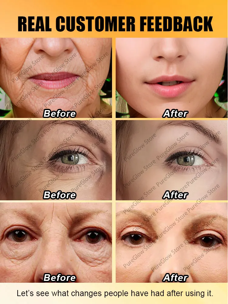 20 years younger  Best choice Nasolabial folds Disappeared