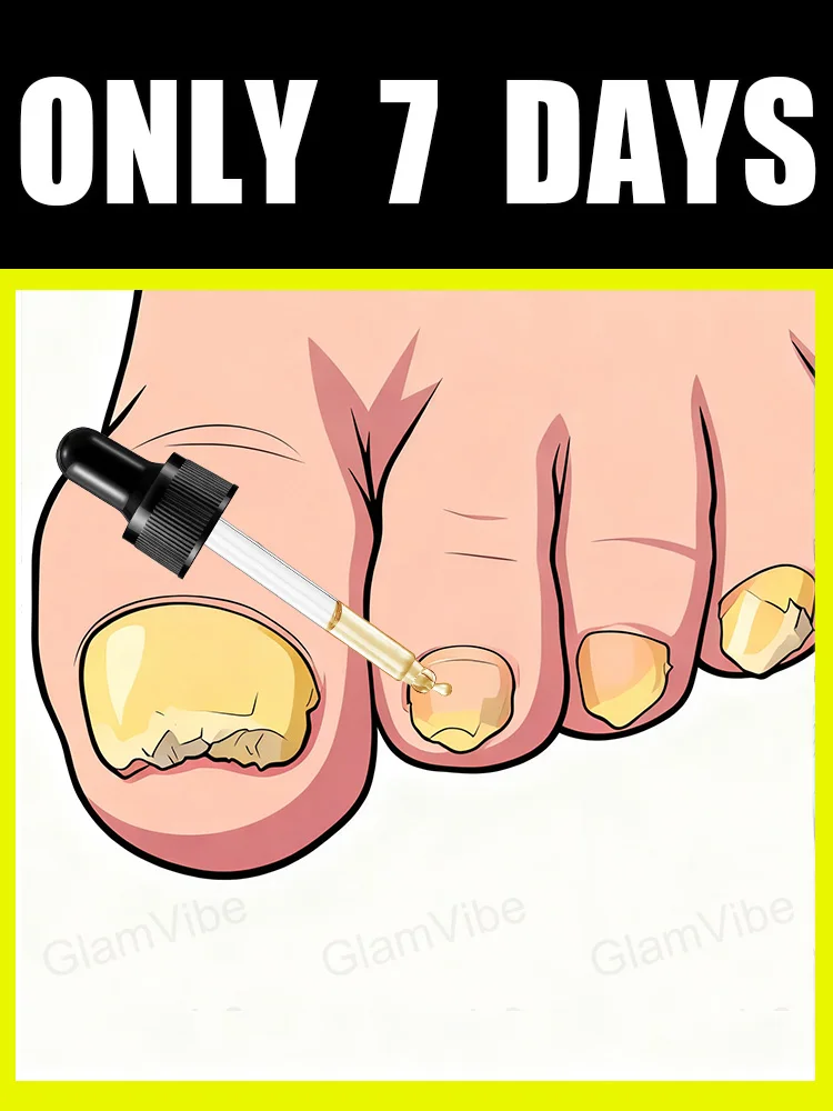 빠른 치료, 곰팡이성 손발톱 걱정에 안녕을!