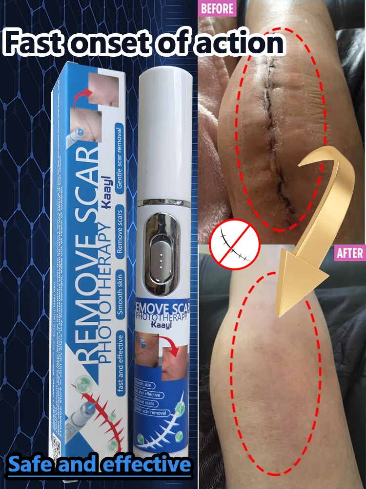 

Laser therapy Keloid scar | Pen for scars | Safe and Efficient